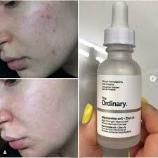 The Ordinary Niacinamide 10% + Zinc 1% โ 30ml